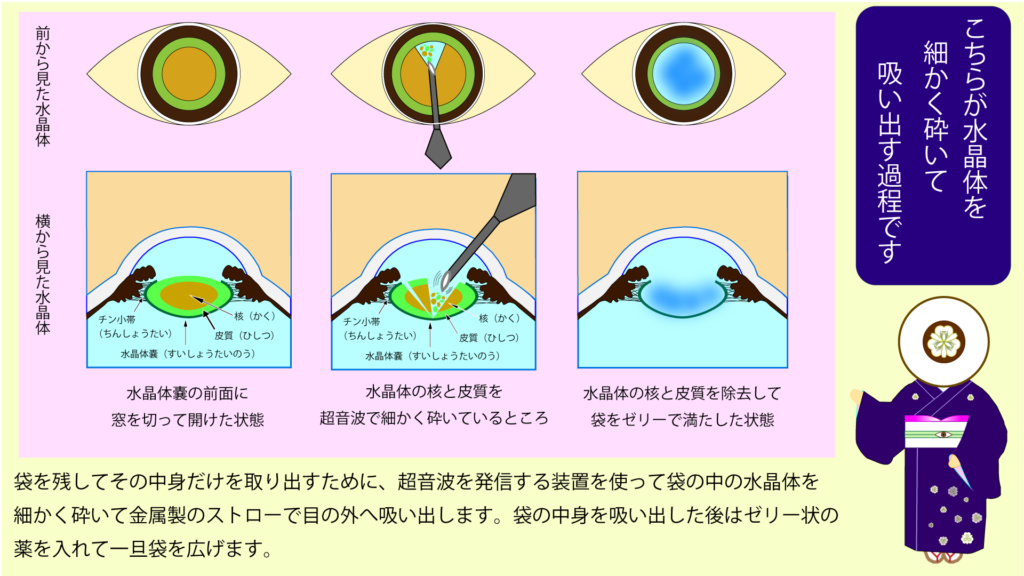 白内障手術はどのように行われますか?